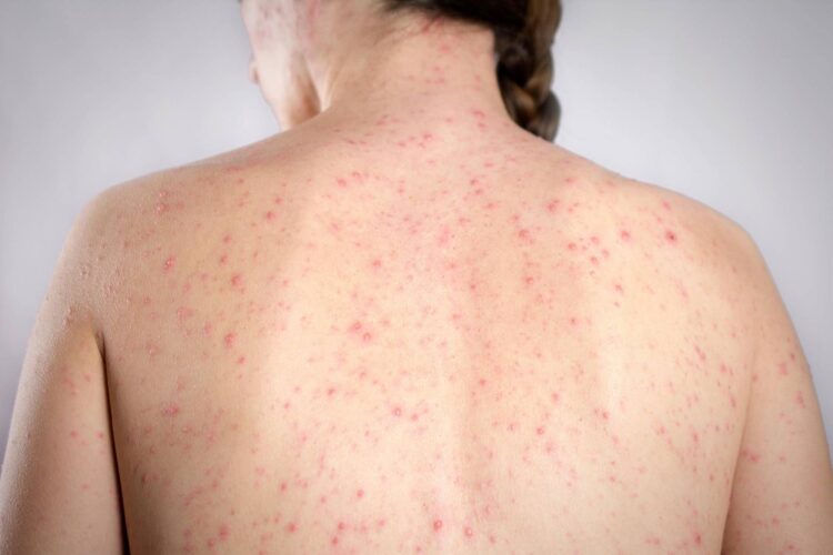 Morbillo, dagli aeroporti Usa alle scuole di Londra: dilagano gli alert